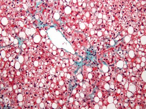 "Non-alcoholic fatty liver disease1" by Nephron - Own work. Licensed under CC BY-SA 3.0 via Wikimedia Commons - http://commons.wikimedia.org/wiki/File:Non-alcoholic_fatty_liver_disease1.jpg#/media/File:Non-alcoholic_fatty_liver_disease1.jpg